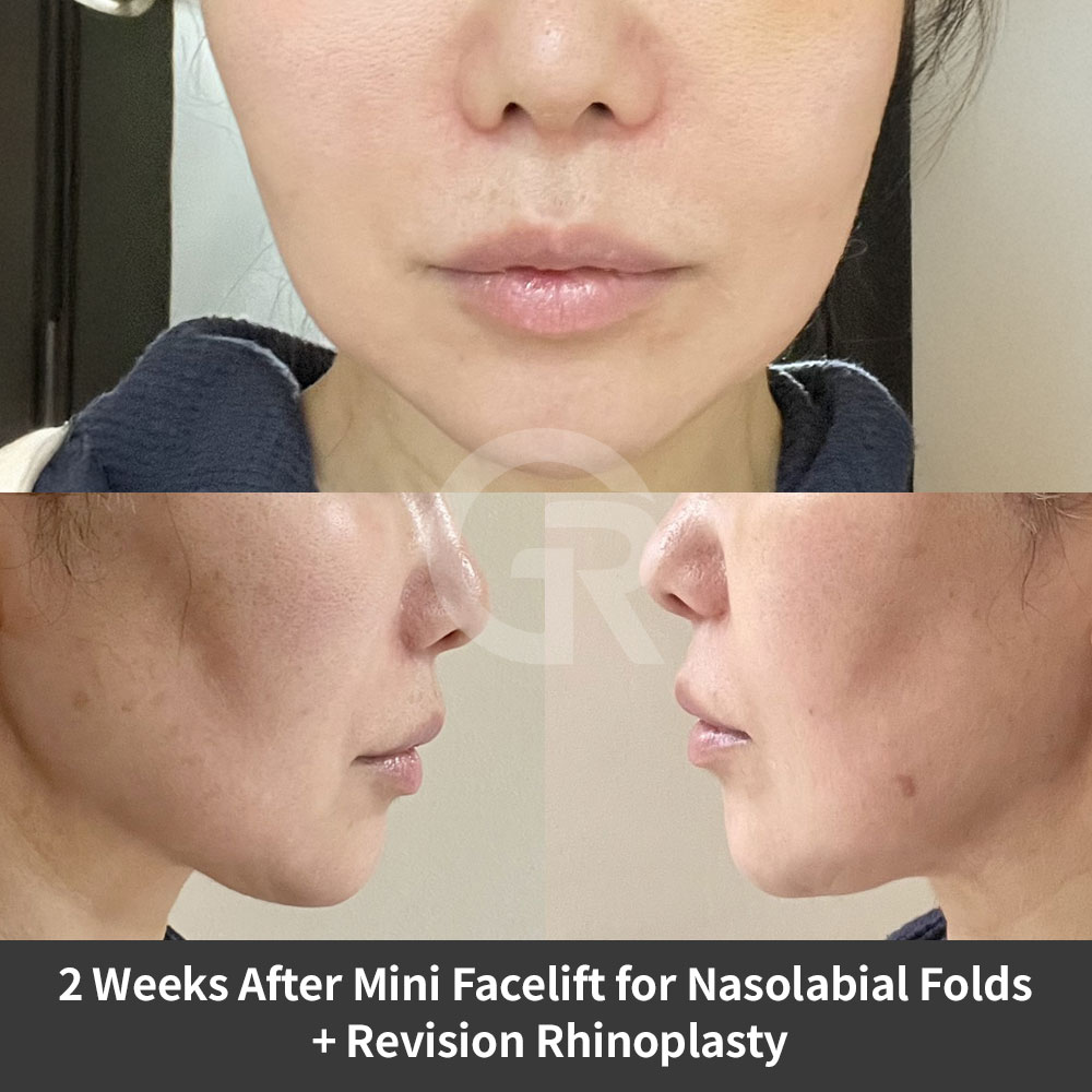 This Girin Plastic Surgery case in Gangnam shows how revision rhinoplasty and wrinkle surgery can be planned together based on facial condition.
