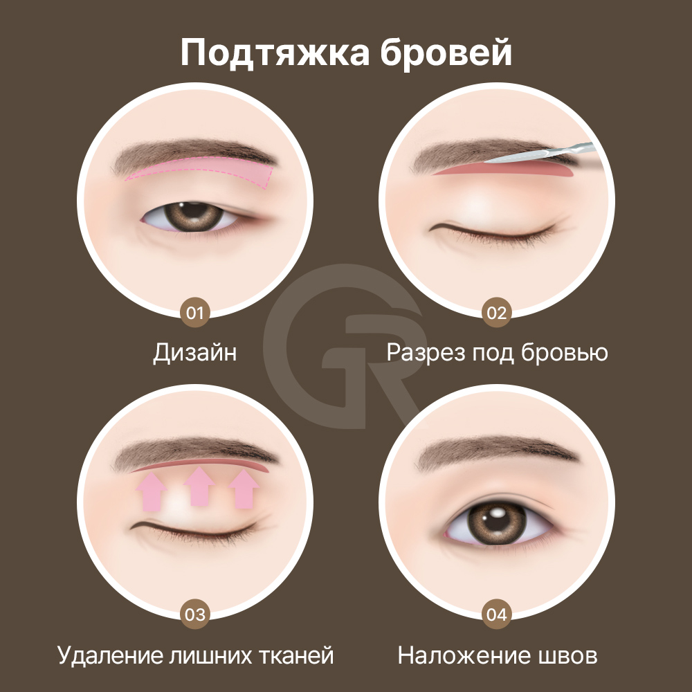 Подтяжка лба помогает поднять брови и улучшает естественное открытие глаз.