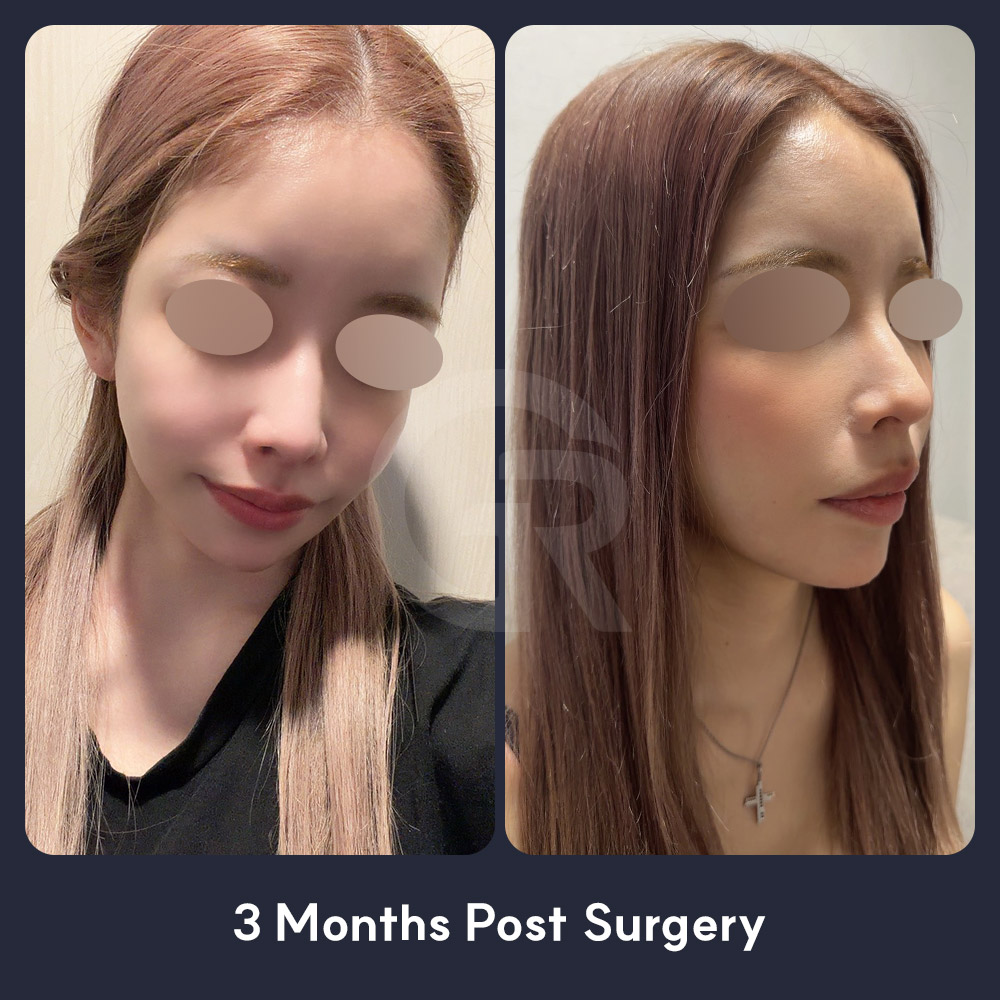 A small and refined K-beauty-inspired face shape should be reinterpreted according to each person’s skeletal structure rather than copied from a celebrity.