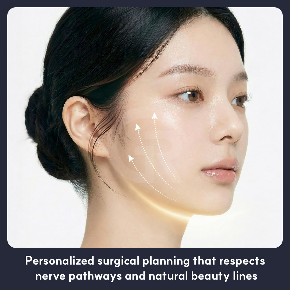 Double chin liposuction in Seoul helps reduce the fat layer under the chin and refine the jawline from the side profile.