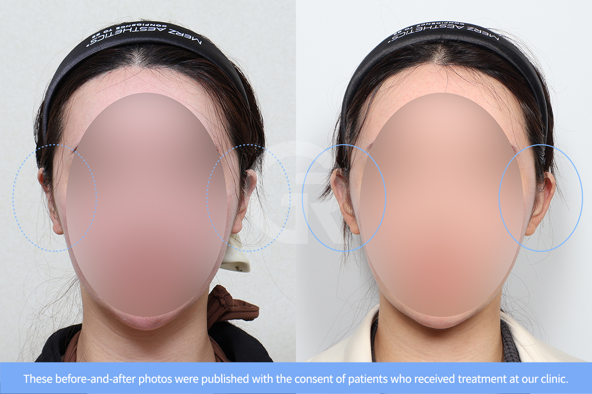 Ear surgery can improve the front view of the face by restoring the natural position of the ears.
