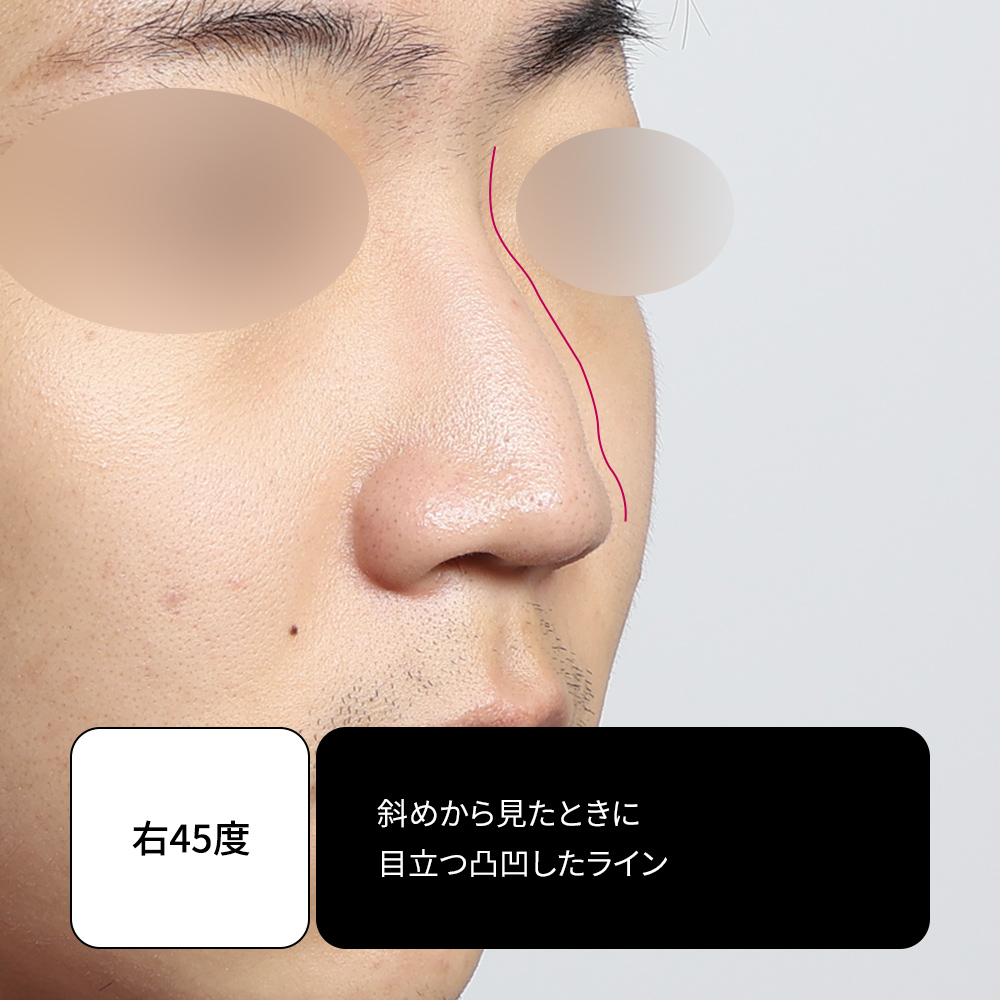 ジェリーコ鼻整形後の回復過程と男性鼻構造の変化。