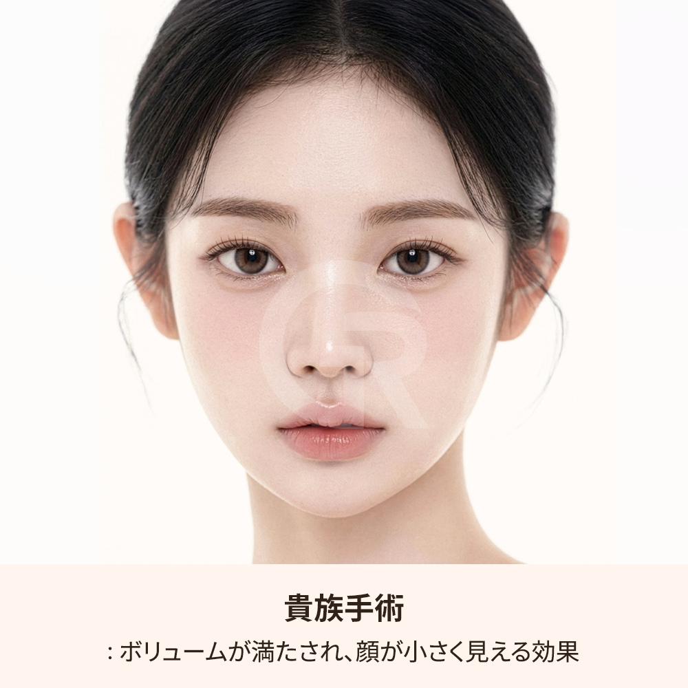 鼻翼基部インプラントによる中顔面の突出感改善