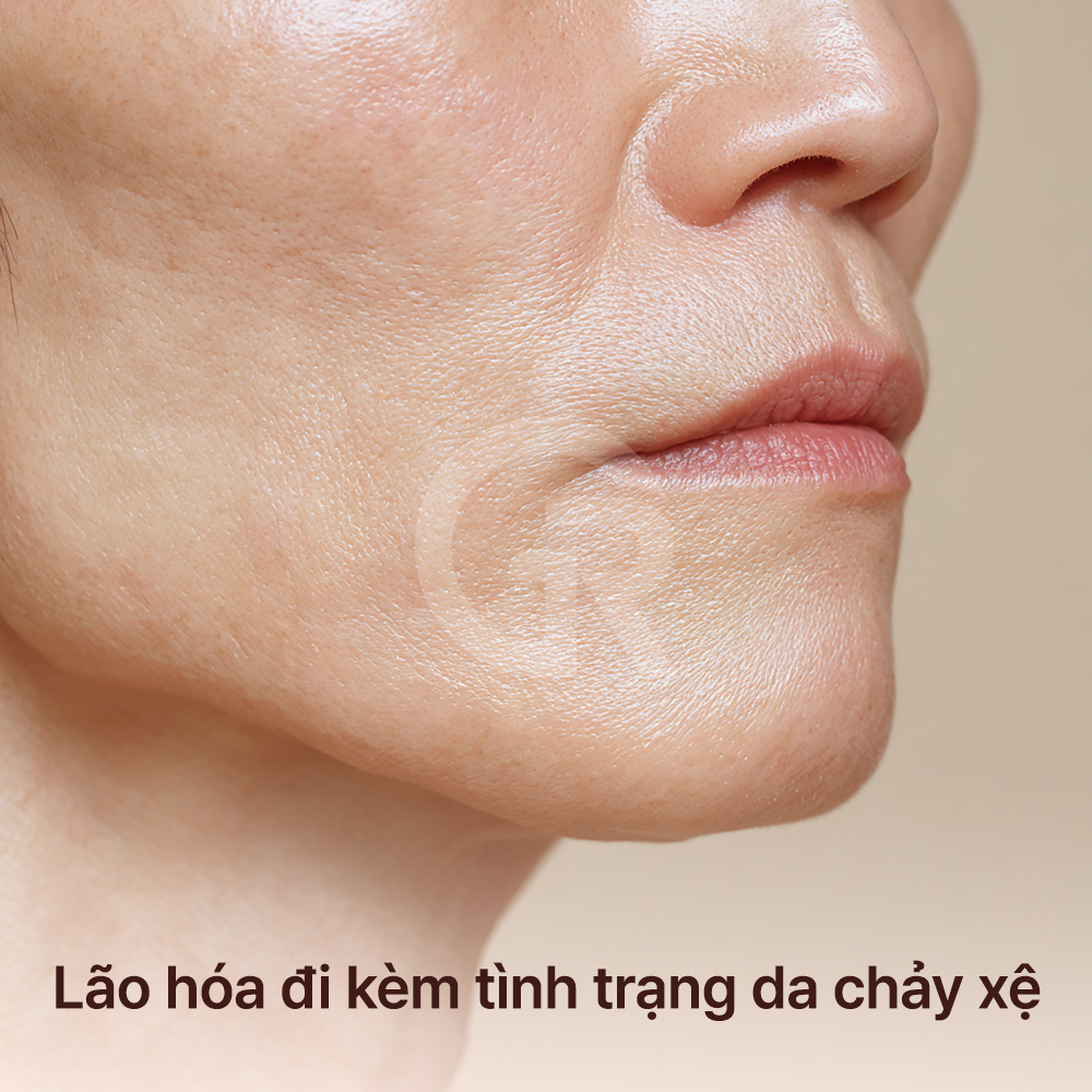 Kết quả cấy mỡ phụ thuộc vào lượng mỡ có thể sống sót và bám lại ổn định sau khi tiêm.