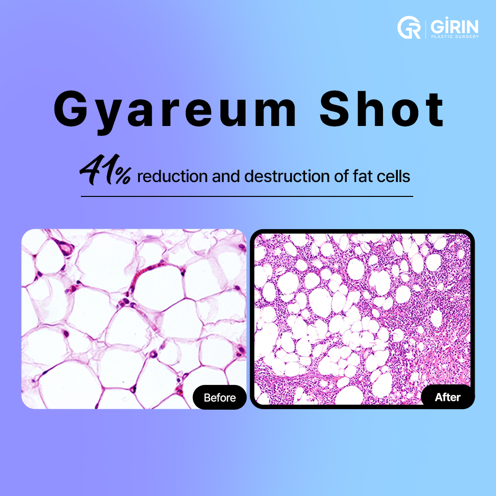 Fat Dissolving Injection in Korea (Girin Gareum Injection)  Real  Experience from the Chief Surgeon : blog