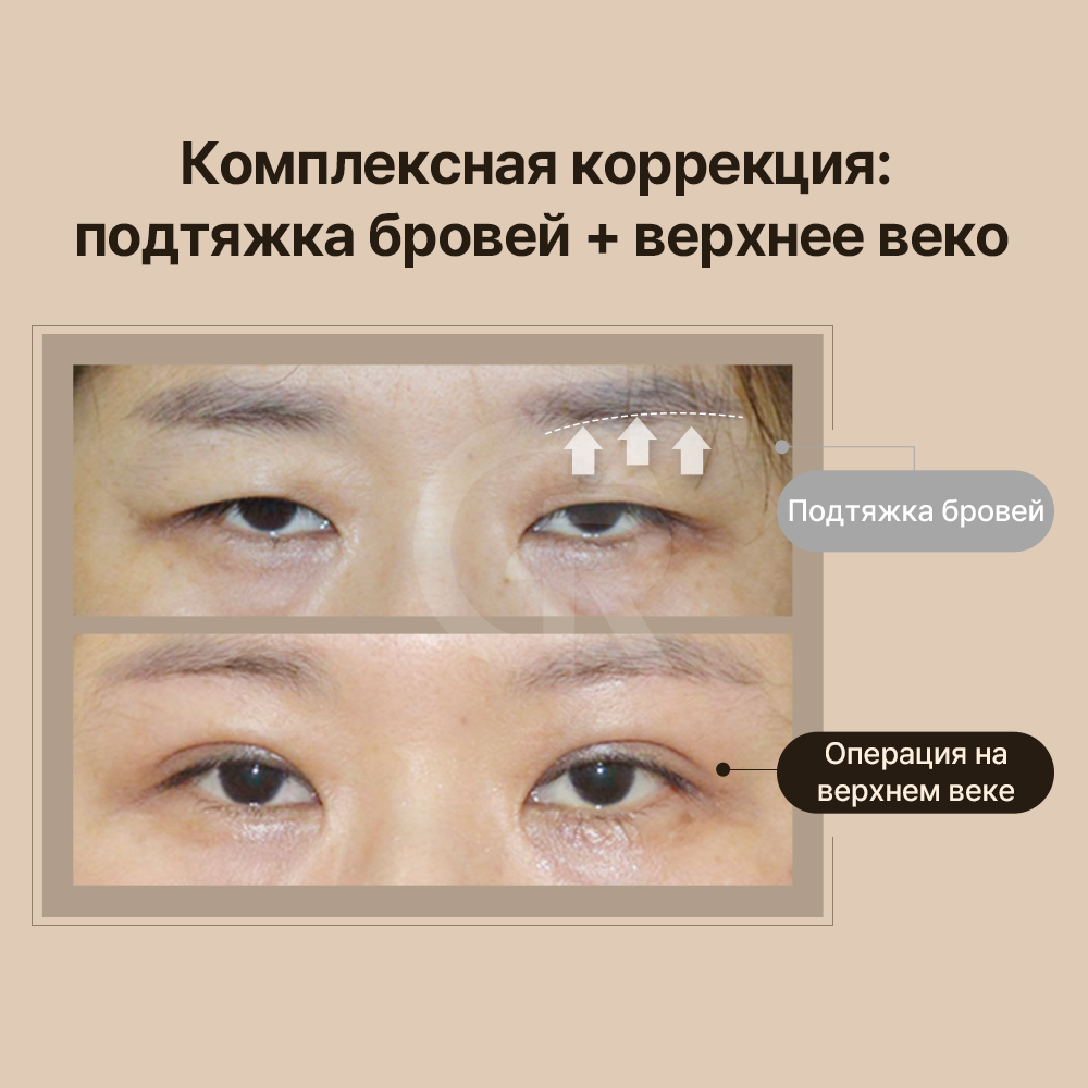 Перераспределение жира под глазами даёт более естественный результат, чем его удаление.