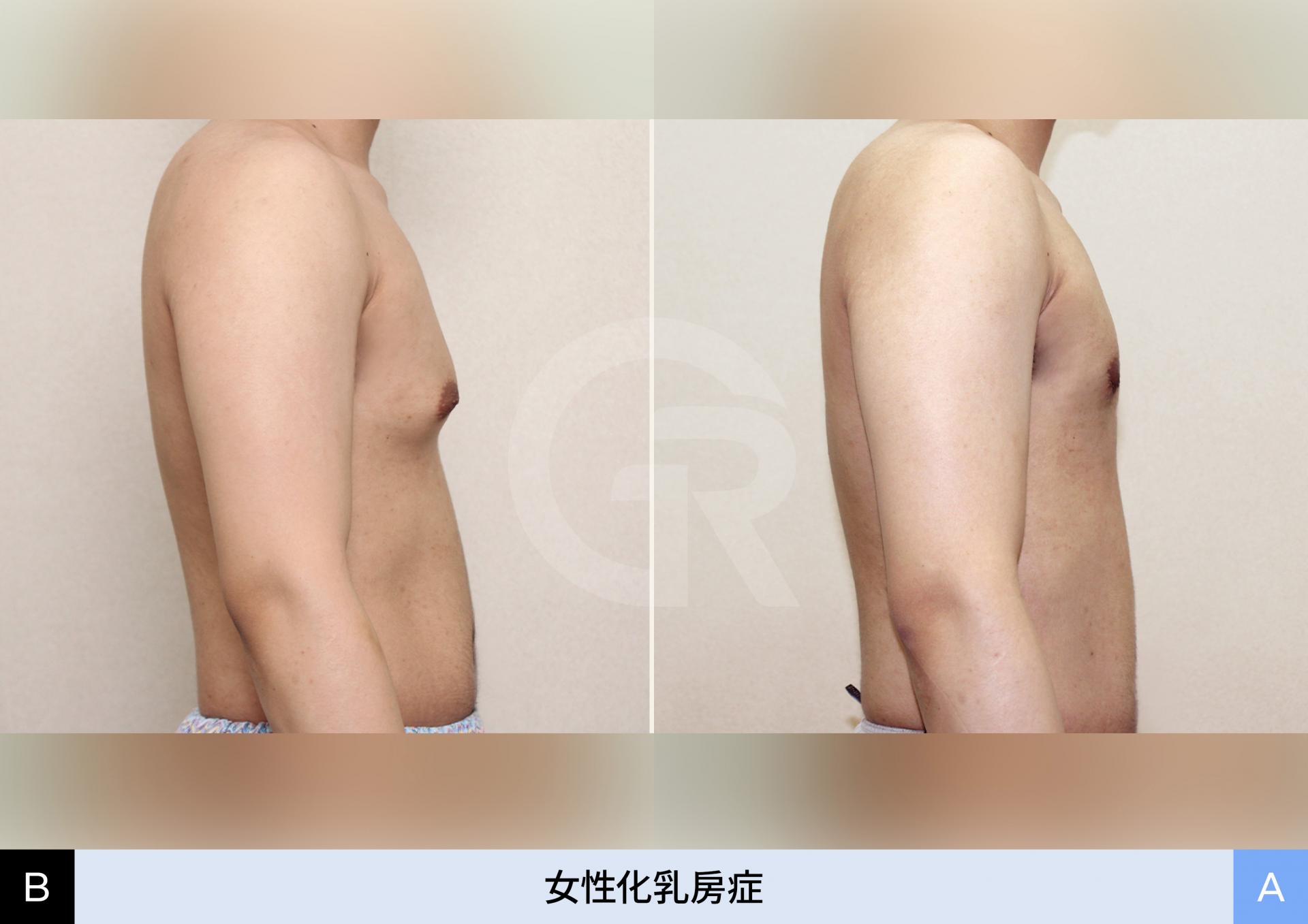 スリム体型の男性に対する乳腺切除の結果