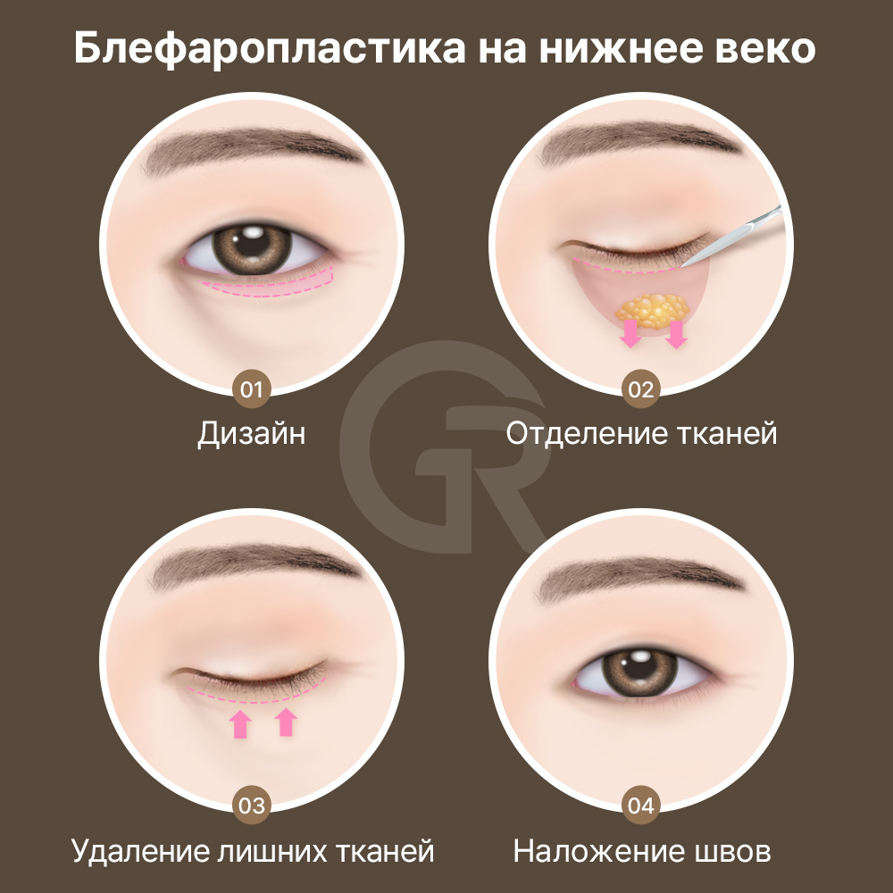Если вы напрягаете лоб при открытии глаз — это может быть признаком опущения структур.