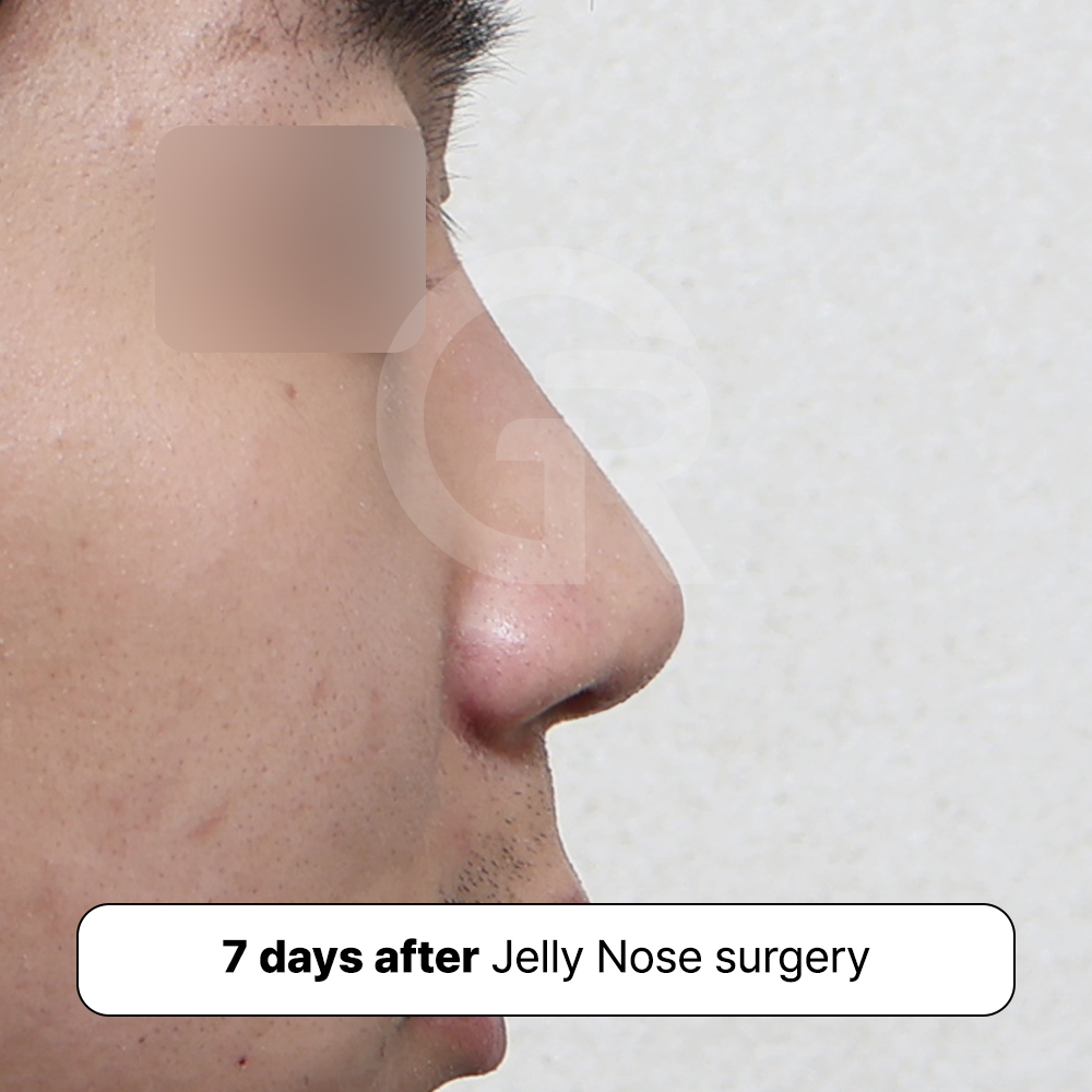 Combined rhinoplasty case correcting hump nose and bulbous nasal tip in a male patient at GIRIN PLASTIC SURGERY.