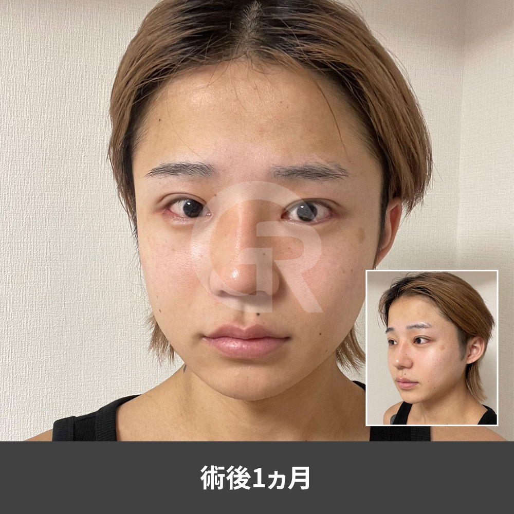 セミアウトラインの二重は、男性の目元を重く見せすぎず、よりはっきりと開いた印象に整える方法の一つです。