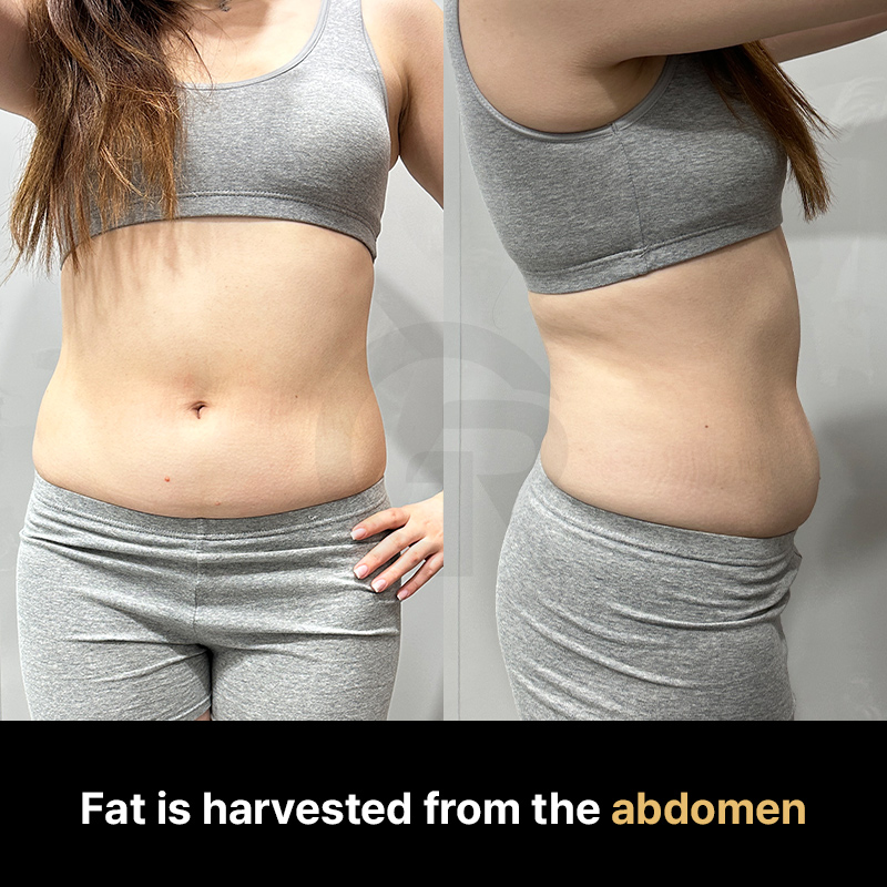 Compared to blood-derived cells, adipose tissue is considered a richer source of regenerative cells.