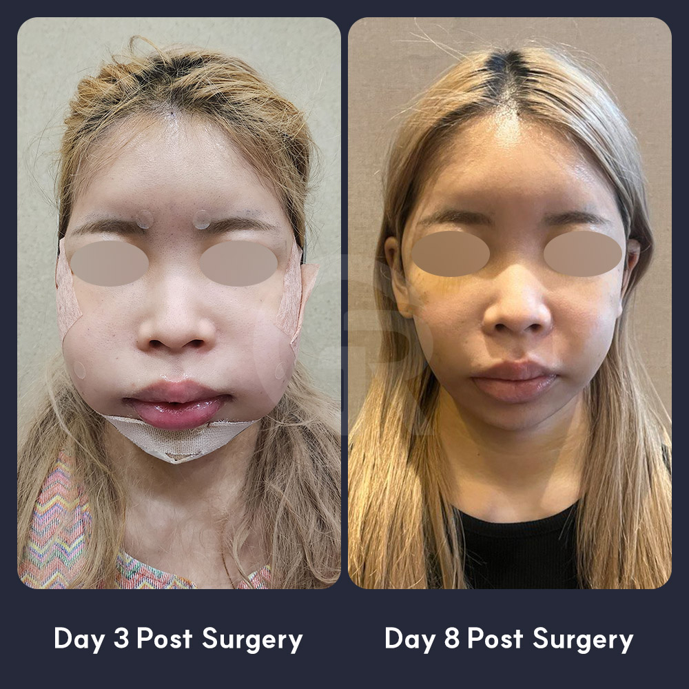 Chin advancement can help improve lower-face balance when the mouth appears more protruded due to a recessed chin tip.