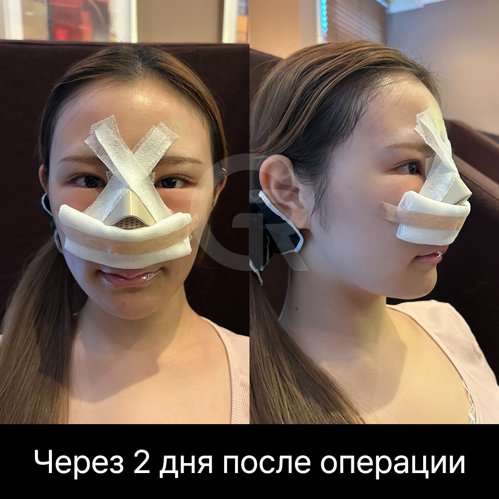 В клинике пластической хирургии Girin в Корее дизайн ринопластики планируется с учетом исходной структуры носа и пропорций лица.