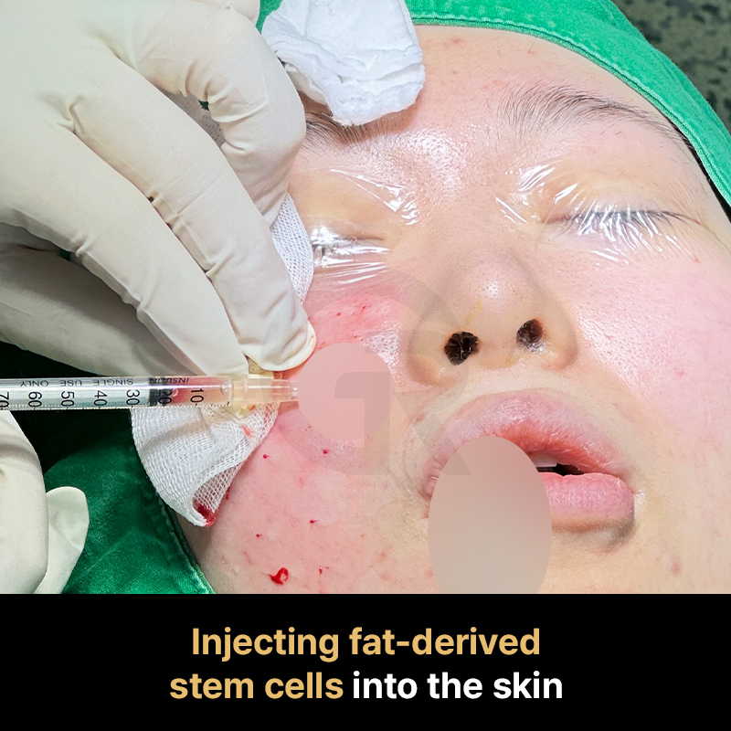 SVF therapy in Korea uses a heterogeneous cell population derived from a patient’s own adipose tissue.