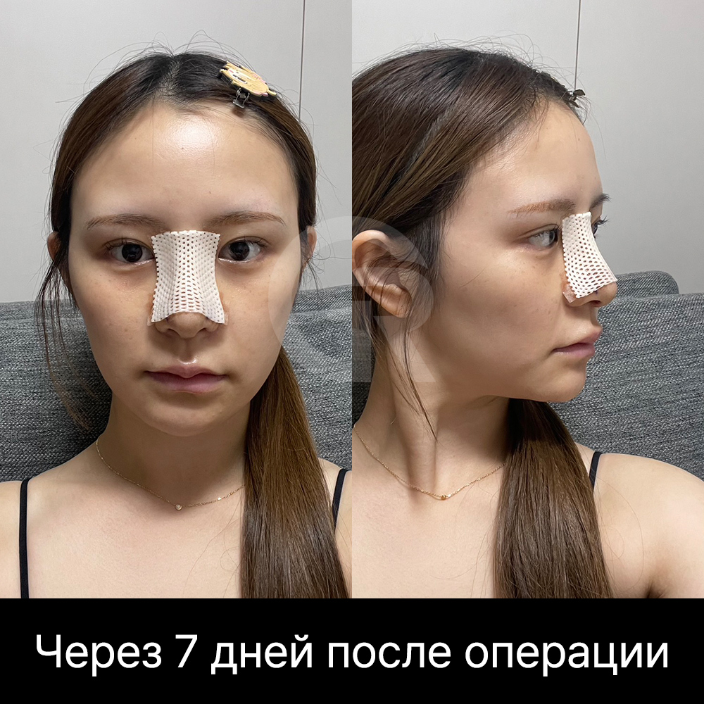 Коррекция мясистого носа не должна делать кончик чрезмерно острым; важнее сохранить естественный мягкий контур.