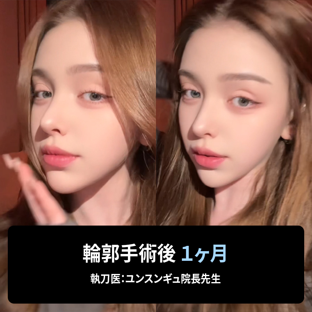 輪郭整形専門医ユン院長による症例紹介。