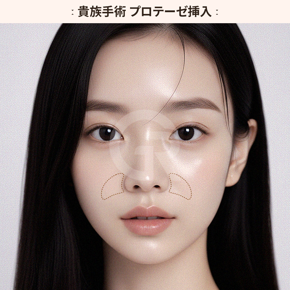 フィラーと鼻翼基部増大術の違い