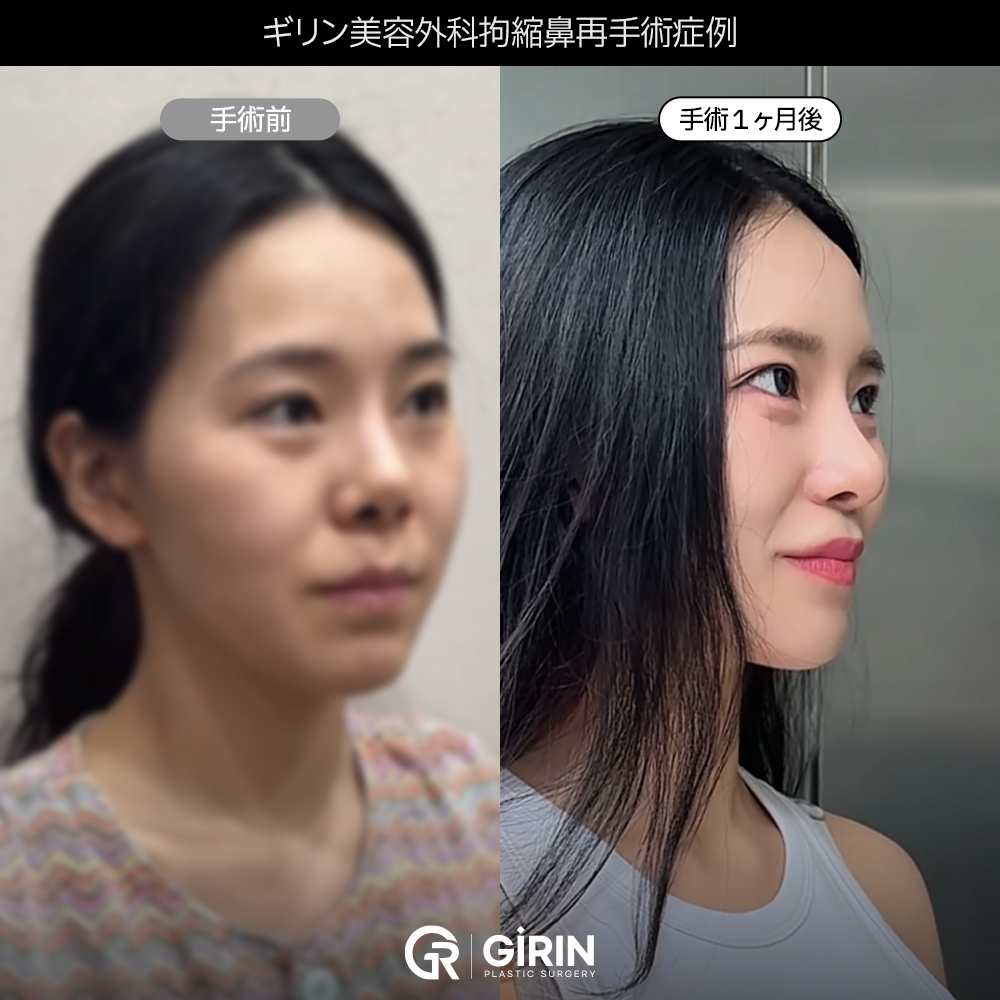 自然で調和の取れた鼻ラインデザイン