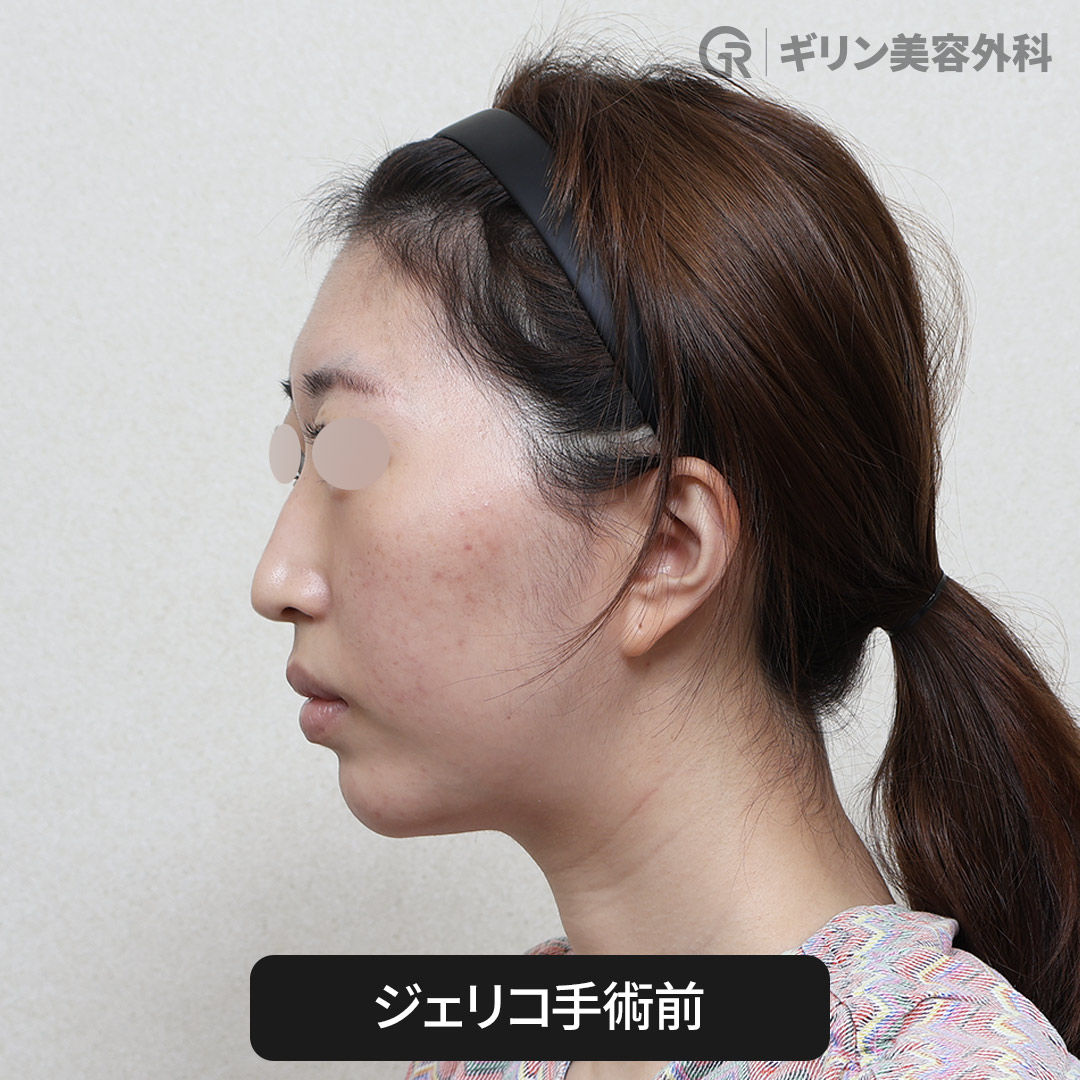 韓国の自然な鼻ラインをつくる最新技術