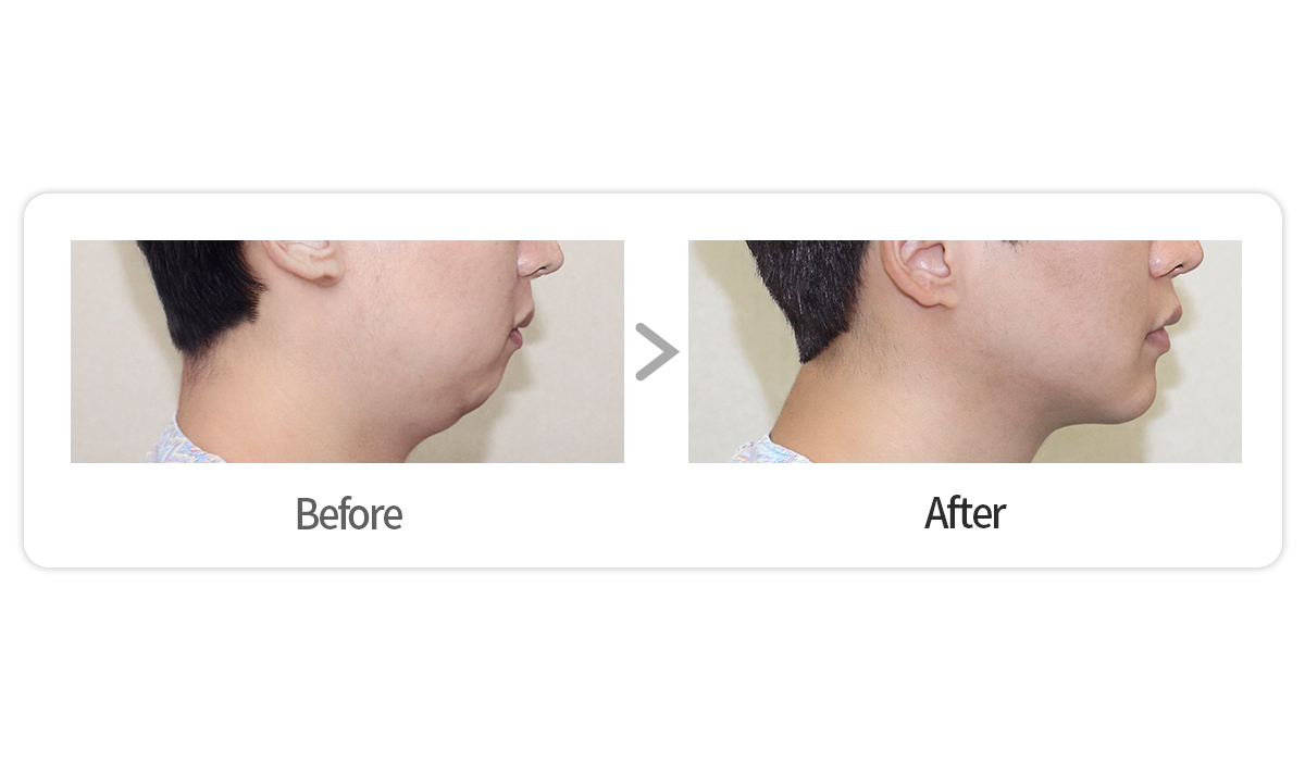 [Girin Plastic Surgery] The Importance of Design in a Male Chin Filler ...