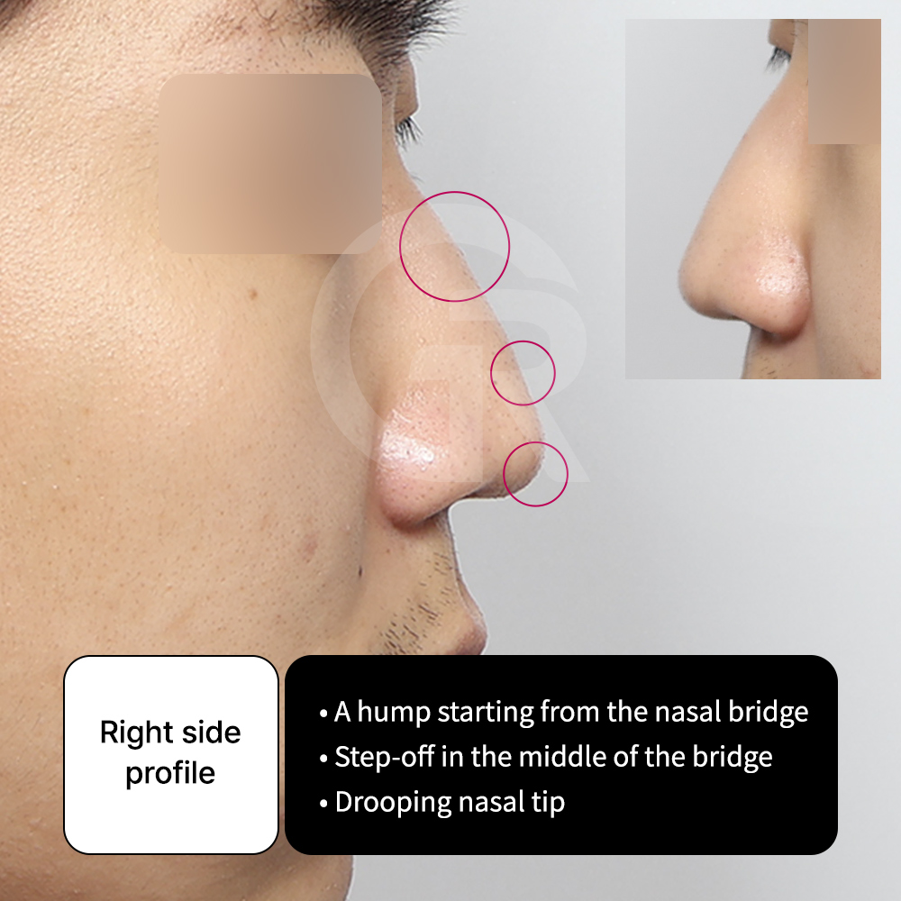 Before and after comparison of hump nose correction performed at GIRIN PLASTIC SURGERY, a well-known nose surgery clinic in Korea.