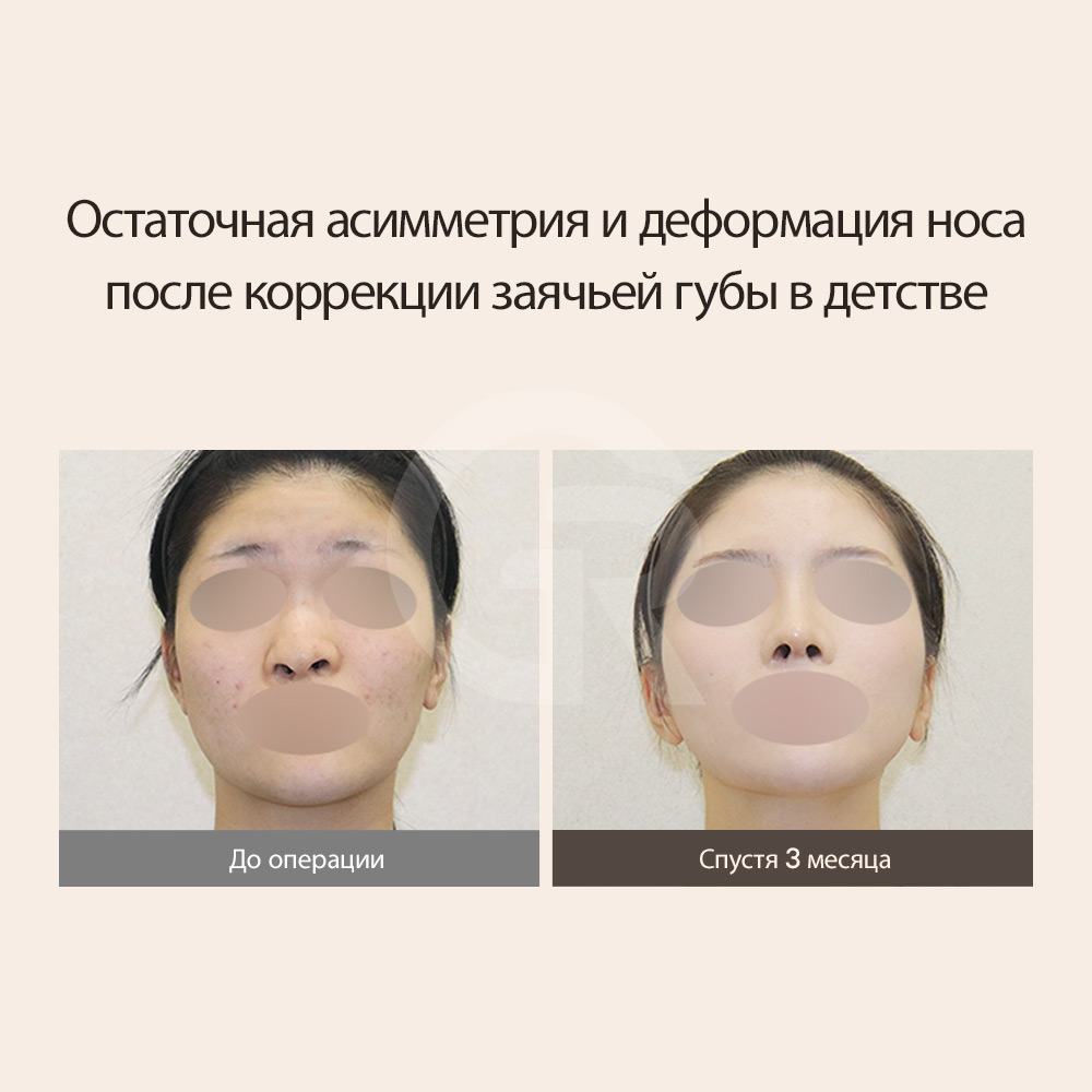 Результаты ринопластики при расщелине губы в Корее: до и после, клиника Girin.