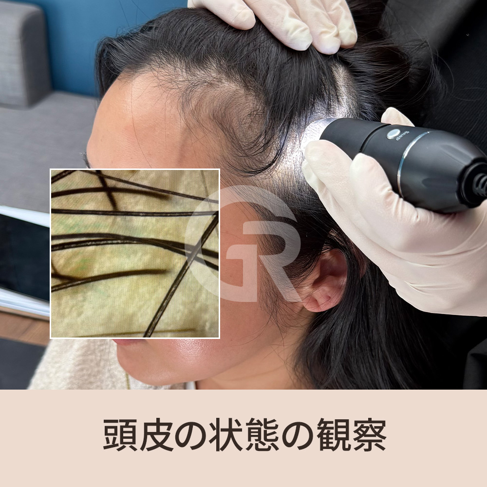 頭皮は顔よりも早く老化の影響を受けやすく、その変化が髪の成長環境に直接影響を与えることがあります