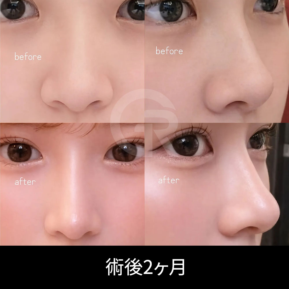 自然なWinter鼻を作るには、鼻筋・鼻先・正面バランスを繊細に調整する必要があります。
