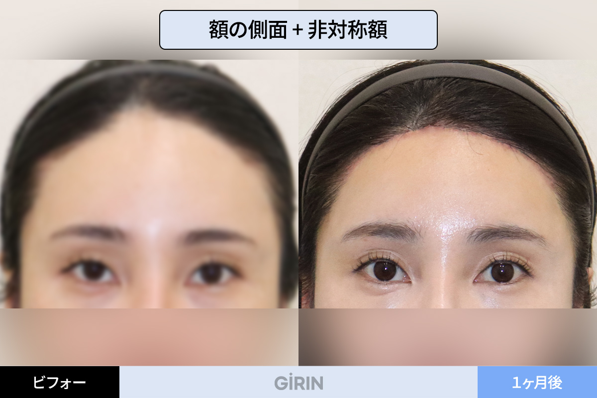 生まれつき高い生え際を自然な位置に整える施術例。