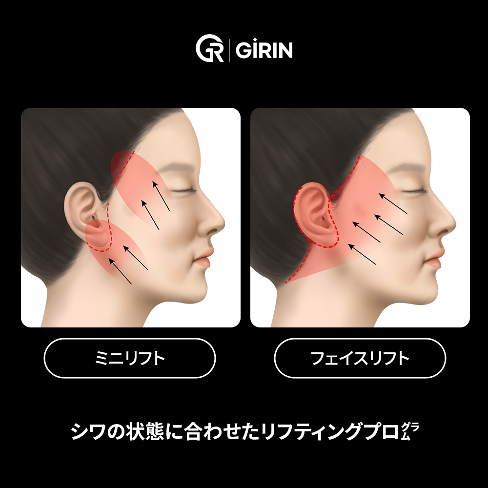 韓国でフェイスリフト手術の費用が異なる理由｜ミニフェイスリフトと