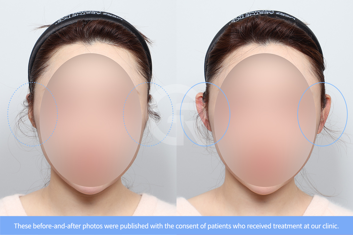 Patients with lop ear often notice improved facial symmetry after ear reshaping surgery.