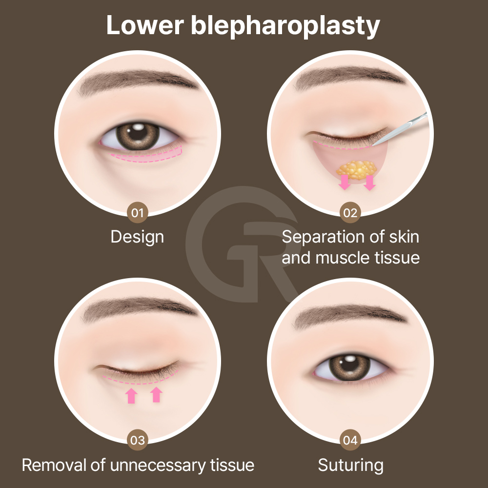 If you feel tension in your forehead when opening your eyes, it may indicate structural drooping.