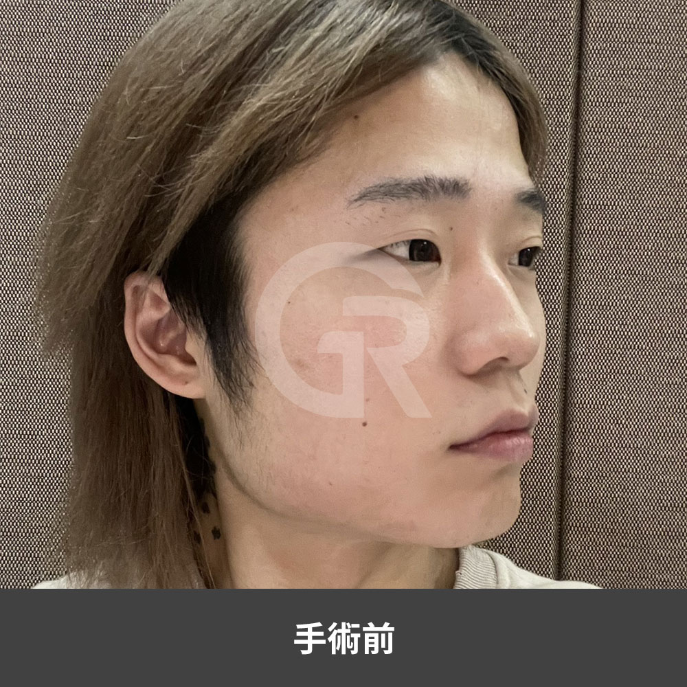 韓国の男性整形では、過度に強い男性的な印象ではなく、自然な顔全体のバランスを重視する傾向が高まっています。