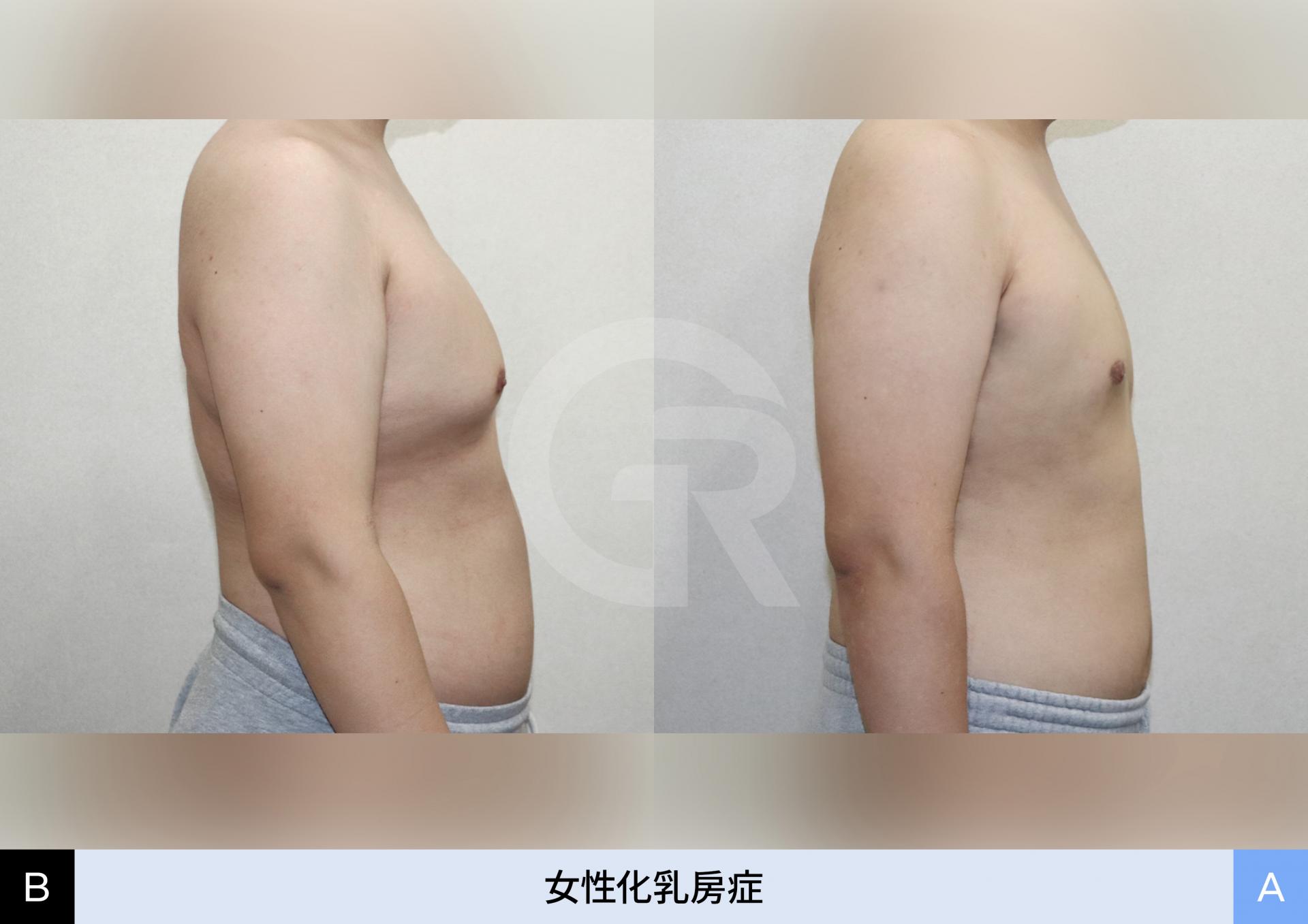 乳輪下の切開で目立たない傷跡に仕上げた例