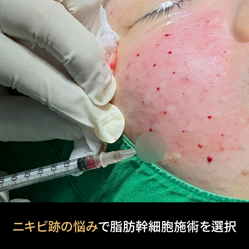 脂肪由来幹細胞注射は、ニキビ跡ケアにおいて補助的に検討されることがあります。