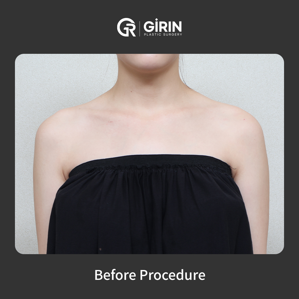 Balanced upper body silhouette through targeted filler