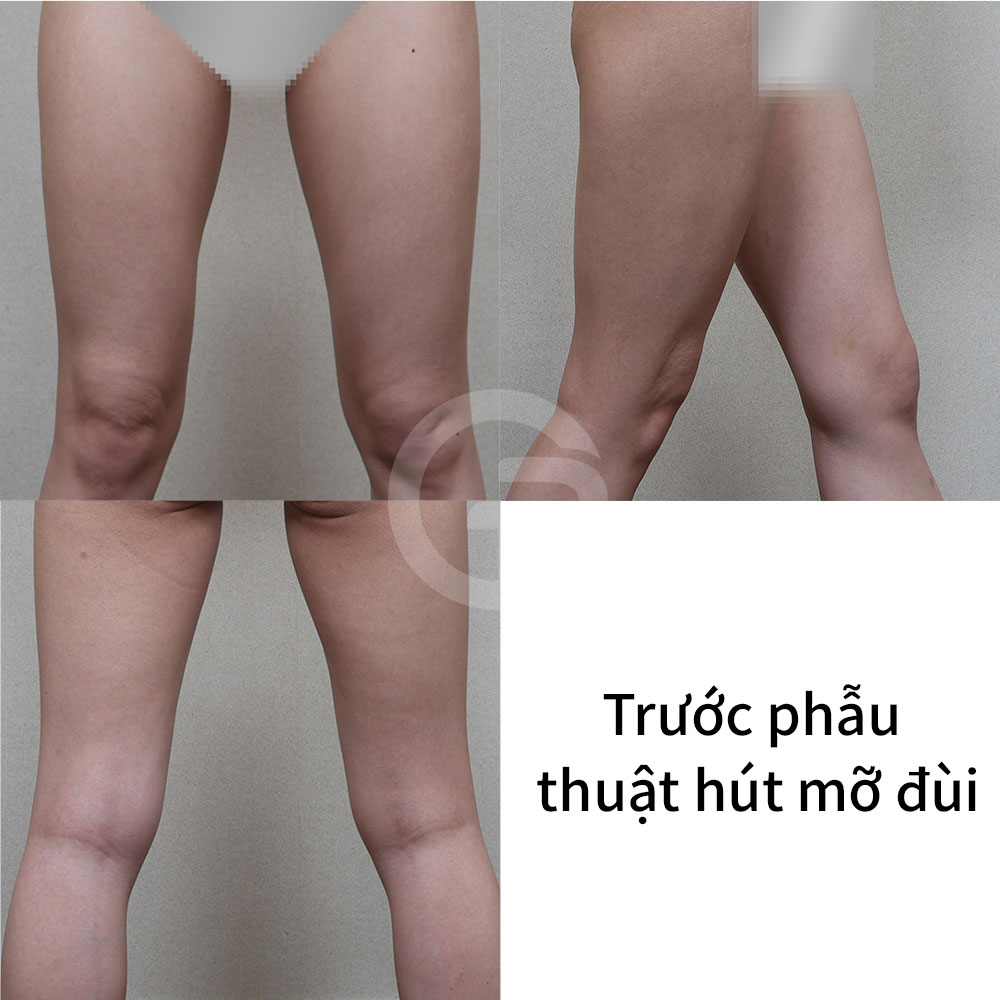 Vùng mỡ đùi ngoài saddlebags cần được tinh chỉnh cẩn thận vì đây là điểm kết nối giữa xương chậu, mông và đùi.