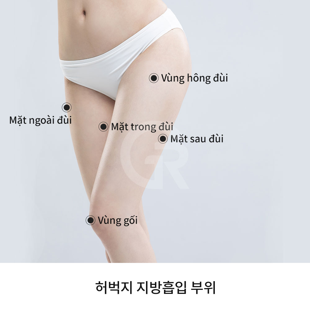 Ngay cả khi cân nặng nằm trong phạm vi bình thường, mỡ tập trung ở đùi vẫn có thể khiến phần thân dưới trông nặng nề hơn.