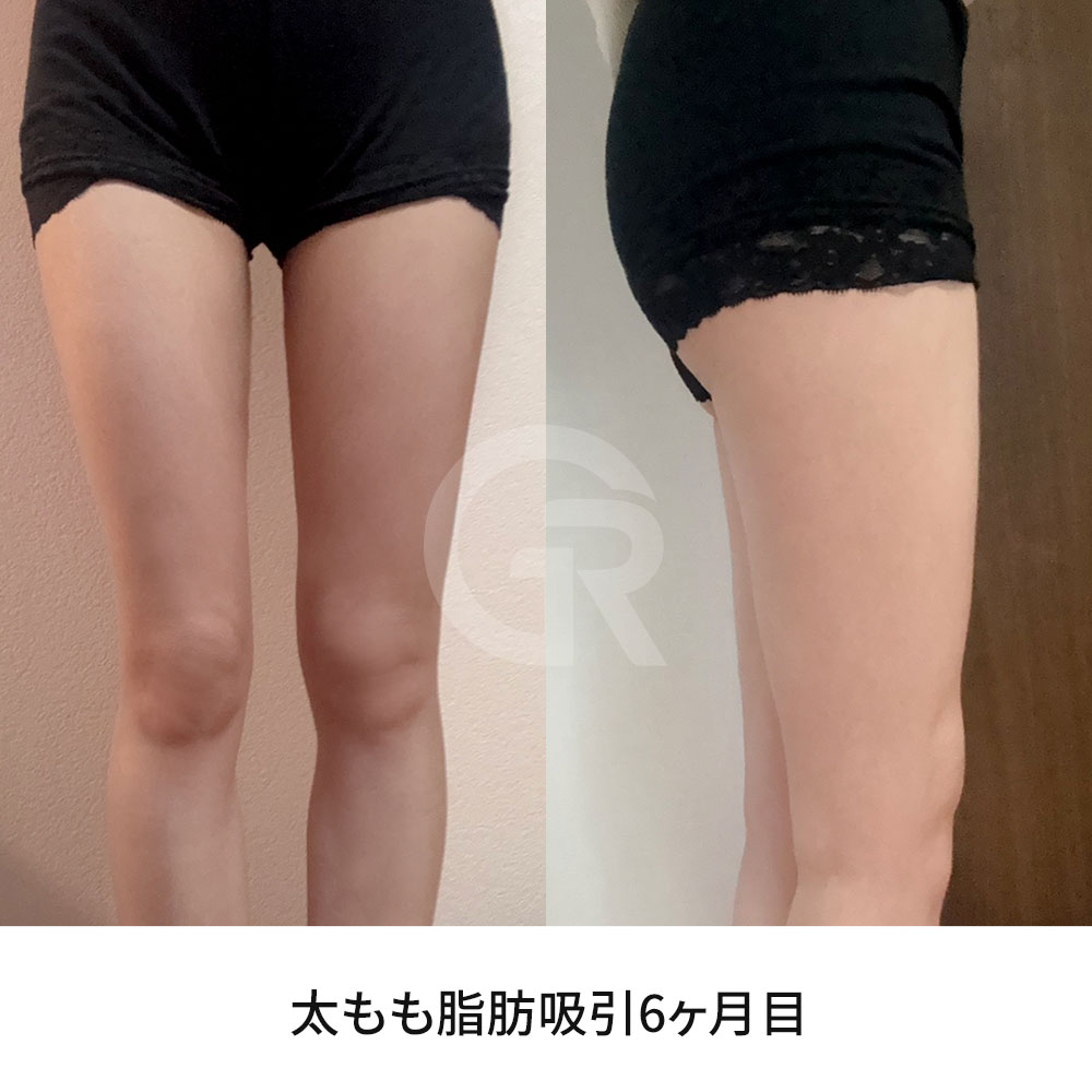ギリン美容外科では、脂肪の分布、ボディライン、全体のバランスを考慮して太もも脂肪吸引を設計します。