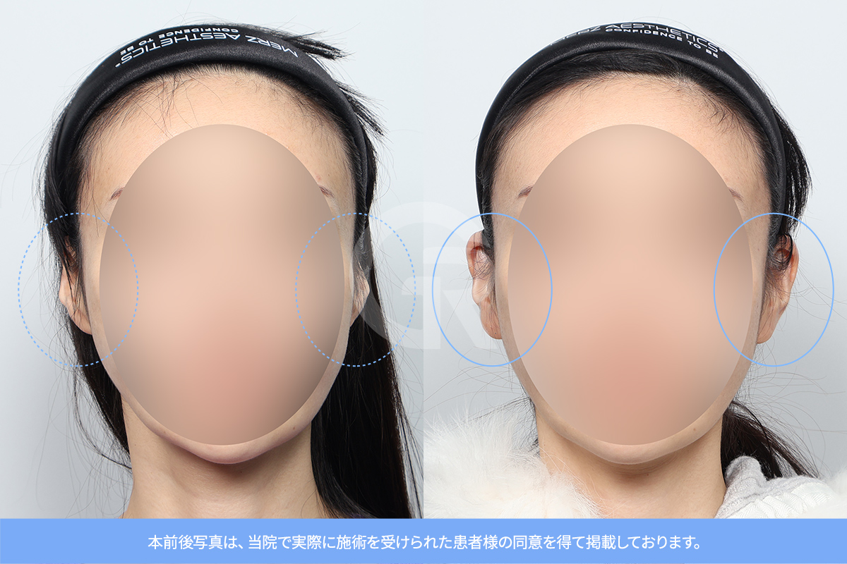 耳整形による側面の変化。耳の角度と輪郭が自然に整えられています。