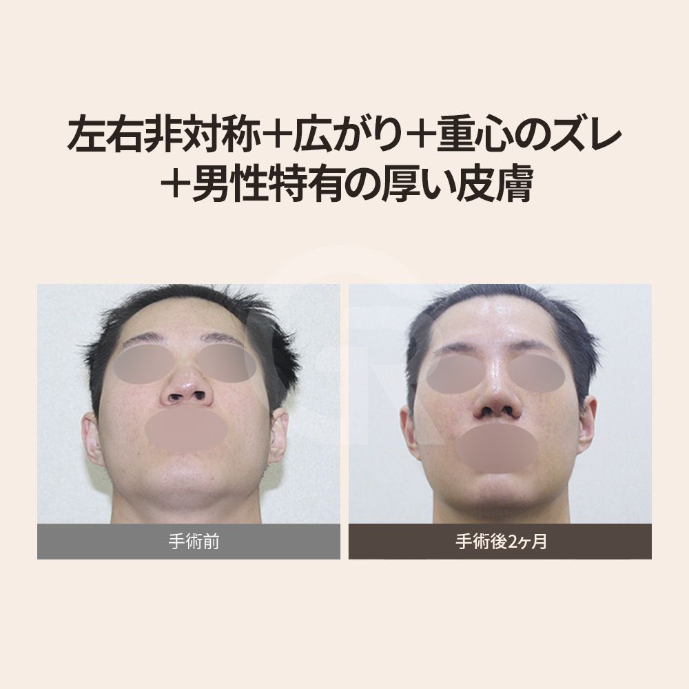 手術前の鼻構造分析、韓国ソウル ギリン美容外科。