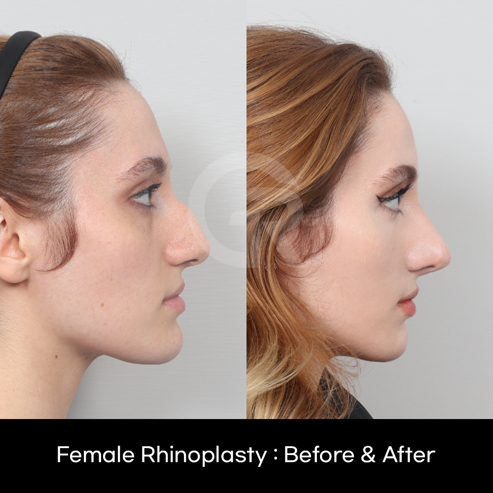 Best natural rhinoplasty in Korea focusing on facial harmony, customized design, and long-lasting results