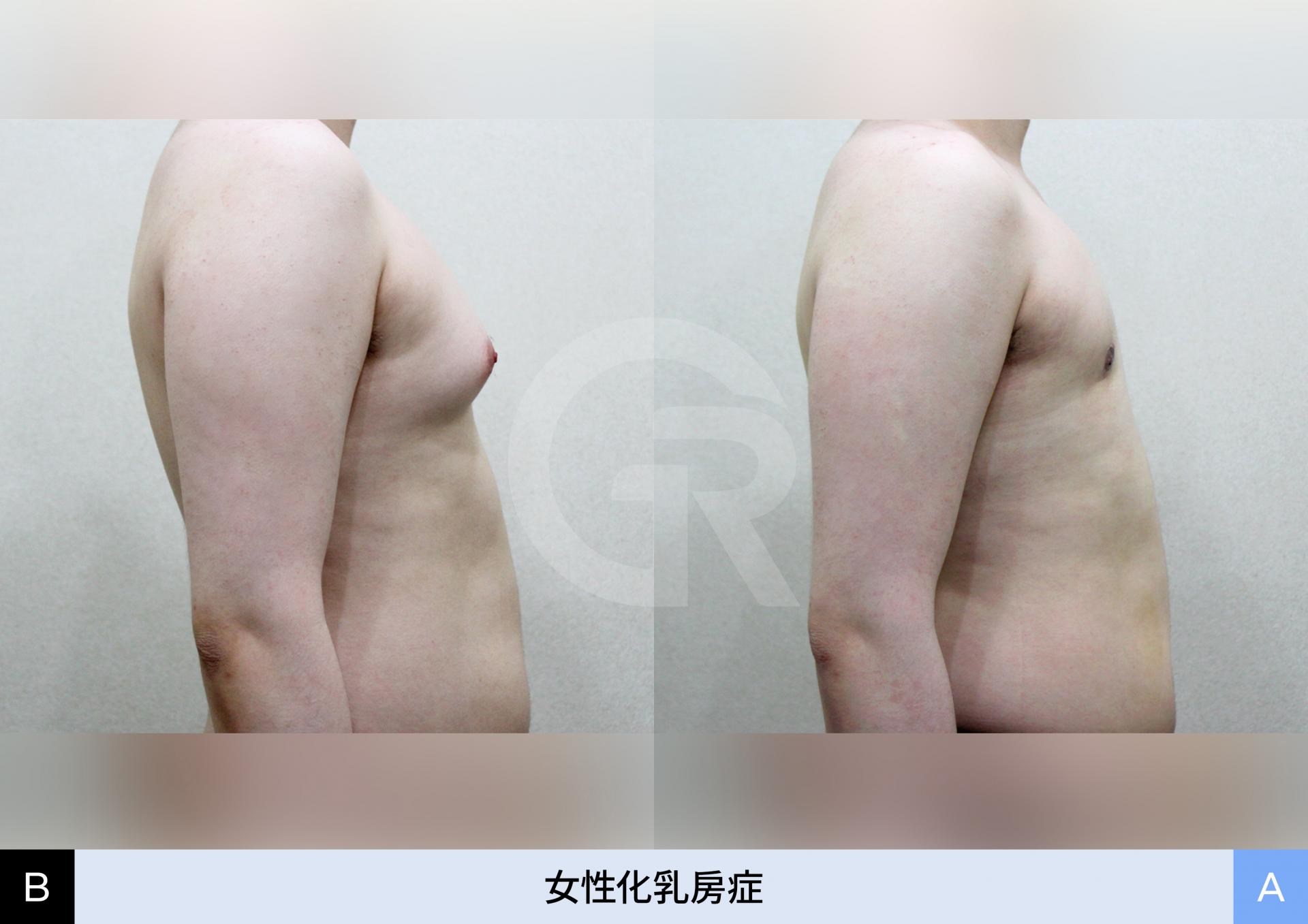 胸の片側だけが膨らんでいた症例の改善結果