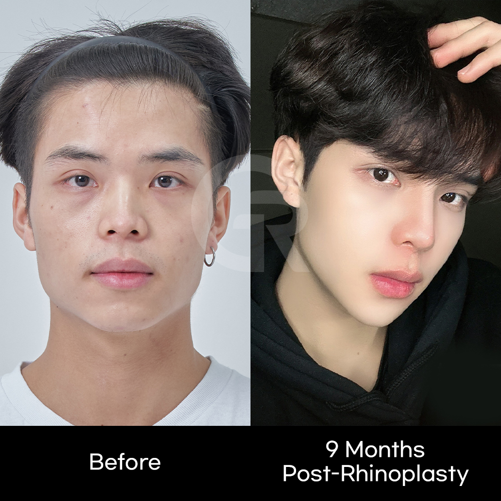 Male rhinoplasty before and after showing improved nasal structure and facial balance with natural-looking results
