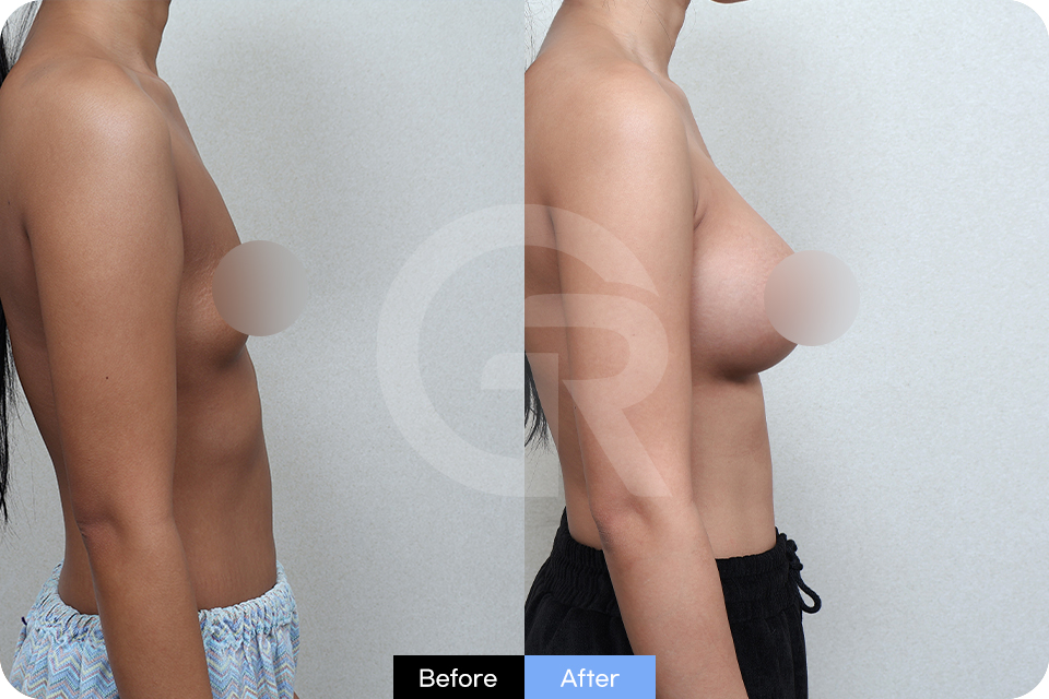 Girin Plastic Surgery Korea Breast Augmentation case 01 Side