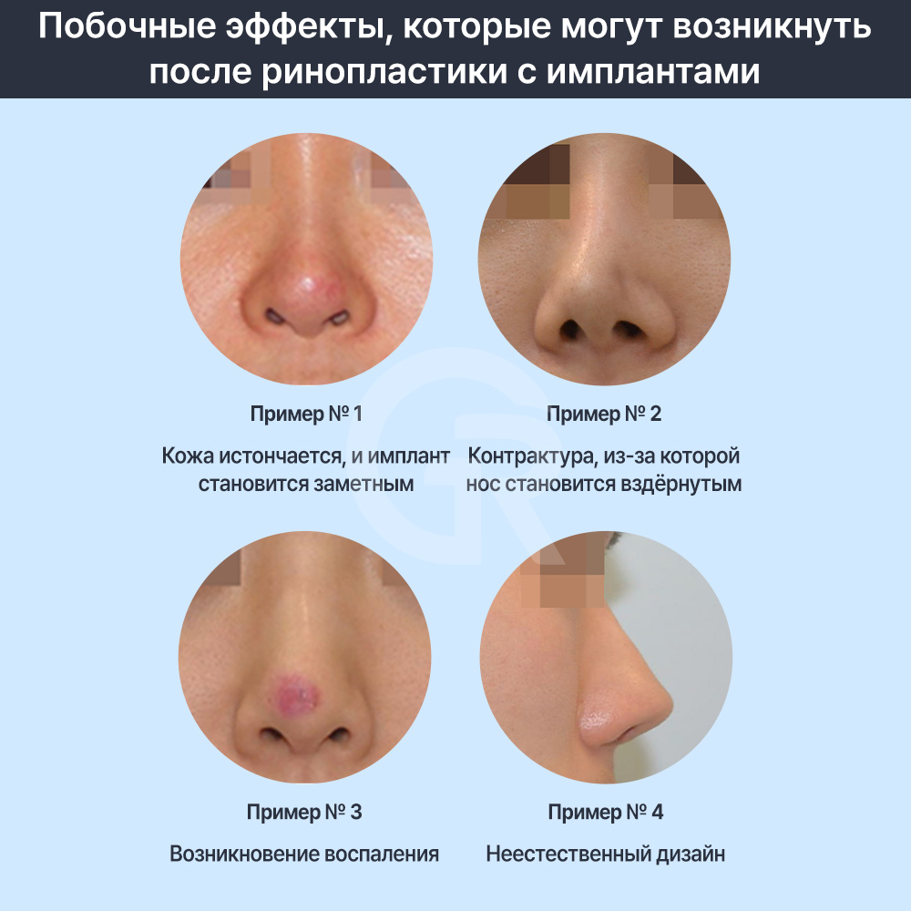 Ринопластика без имплантов направлена на создание естественной линии носа, гармонирующей с лицом.