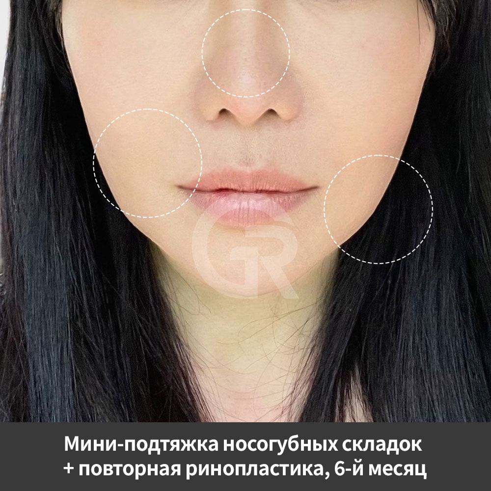 Естественный омолаживающий результат в Клинике Пластической Хирургии Гирин в Корее с акцентом не на чрезмерные изменения, а на гармонию лица.