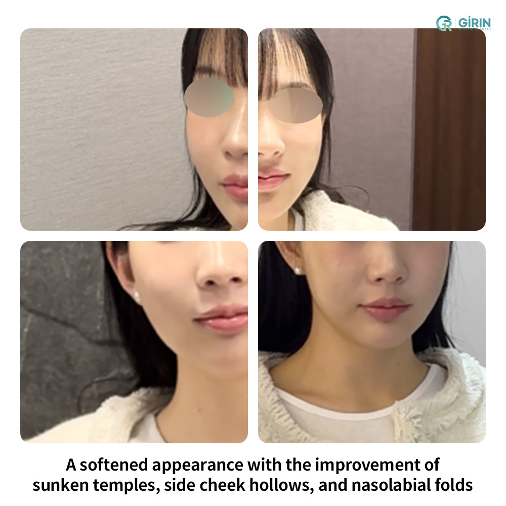 Nasolabial folds frequently deepen when midface and cheek volume decreases.