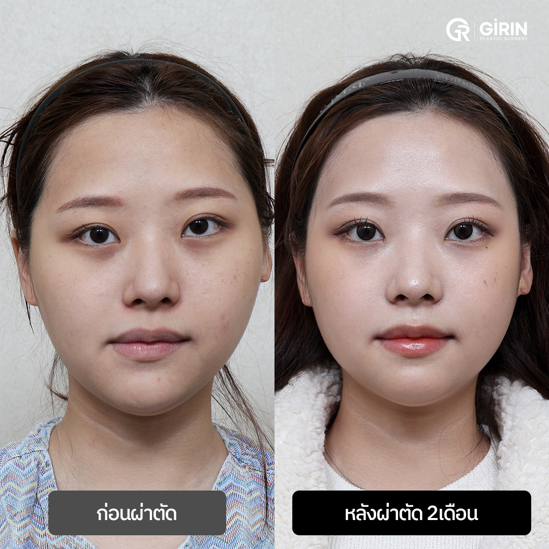 โครงหน้าได้รูปสมดุลมากขึ้นหลังผ่าตัดขากรรไกรแบบ SSRO