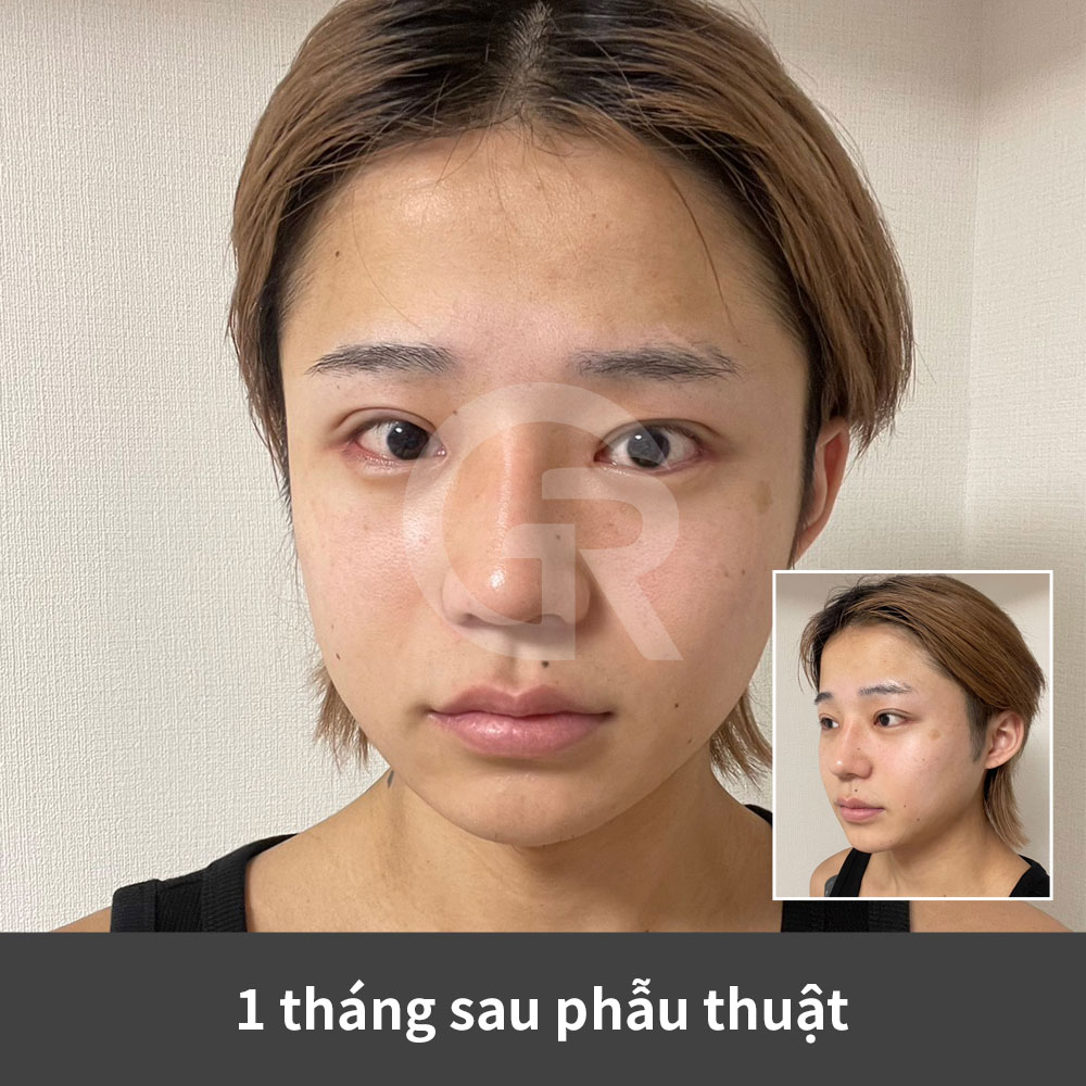 Kiểu mí bán ngoài có thể giúp đôi mắt nam giới trông rõ ràng và mở hơn mà không làm ánh mắt trở nên nặng nề.